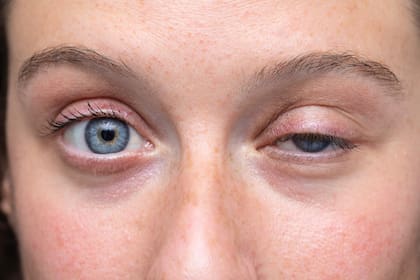 Como tratamiento se puede implementar inyecciones de toxina botulínica en los músculos del ojo o sino probar una combinación adecuada de medicamentos para disminuir el latido