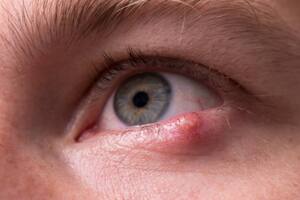 Cuáles son los cuidados para evitar la aparición de orzuelos e hinchazón ocular