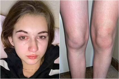 Cada vez que su piel entra en contacto con el agua le provoca una reacción alérgica (Foto: Kennedy News and Media)