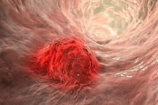 Aprueban en la Argentina una inmunoterapia para tumores sólidos que se aplica a través de inyecciones