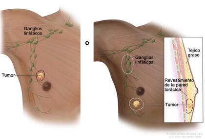 Cáncer de mama masculino (National Cancer Institute)