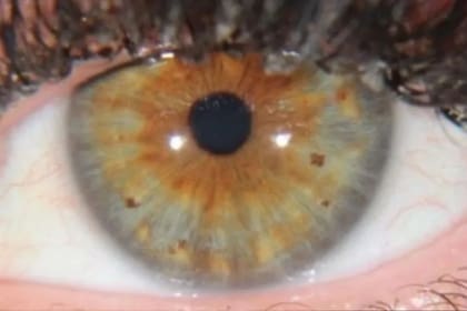 Carly Electric compartió una foto de cómo era su ojo antes de que le cayera un rayo