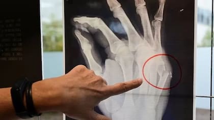 Cerca de 178 millones de nuevas fracturas óseas ocurren en el mundo cada año. Suceden por varias razones, que incluyen caídas o lesiones deportivas