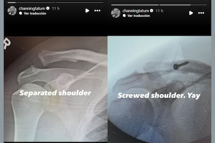 Channing mostró las placas con la lesión y el tornillo que le injertaron