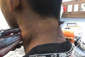 Cinco médicos retiraron lo que quedaba del pez espada en una cirugía de una hora de duración