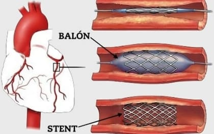 Colocación de un stent