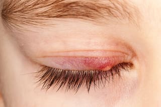 Cómo curar un orzuelo