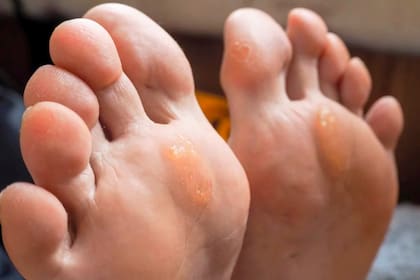 Cómo eliminar los callos y las durezas de forma sencilla y efectiva