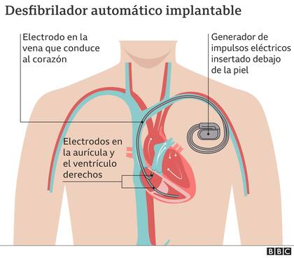 Cómo funciona el desfibrilador automático implantable