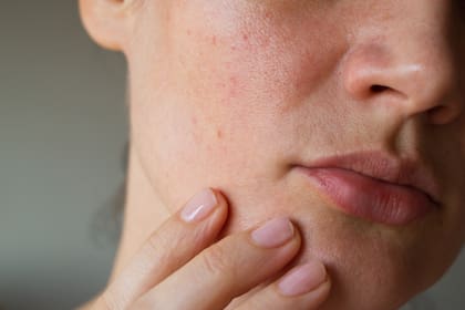 Cómo identificar los tipos de manchas rojas en la piel y los distintos tratamientos para quitarlas