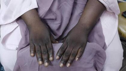 Como los nudillos tienden a permanecer del mismo color, quienes se someten a estos tratamientos son confundidos con fumadores o drogadictos.