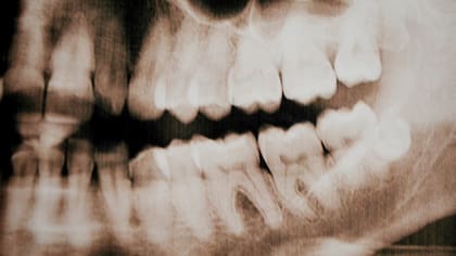 A veces la dentadura puede permitir establecer la identidad de un cuerpo