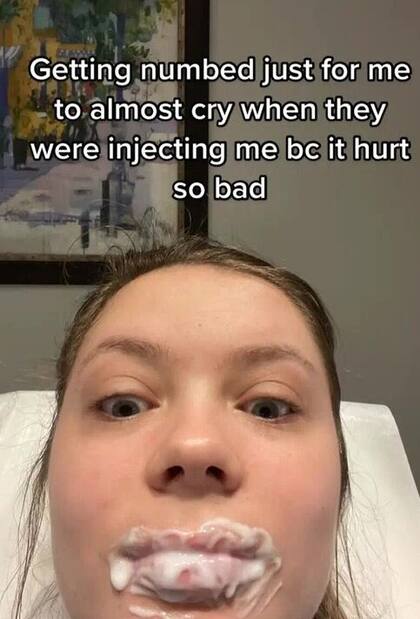 Con la crema anestésica sobre los labios, Emma espera el procedimiento