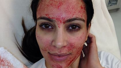 Con sangre en el rostro, Kim Karadashian mostró su ''vampire facelift''