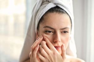 Cómo es el tratamiento contra el acné que usa bacterias para combatirlo