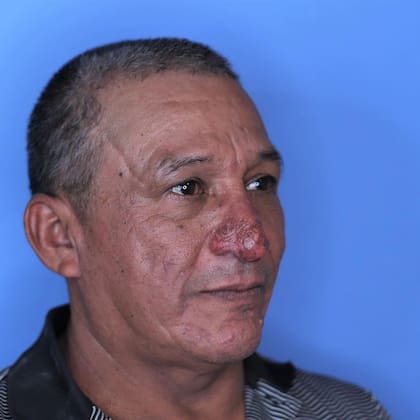 Conrado Ramos Estrada se sometió a una operación para poder cambiar su calidad de vida