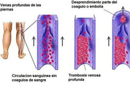 Consecuencias de una trombosis en la pierna