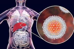 Detectan el primer caso de hepatitis aguda grave del país