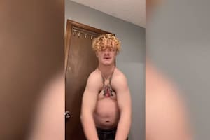 Corey Bennet, un joven de 19 años, de Indiana, Estados Unidos, nació sin clavícula debido a una rara enfermedad llamada disostosis cleidocraneal