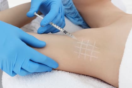 La aplicación de botox en las axilas es un procedimiento sencillo que tiene efecto por 8-9 meses