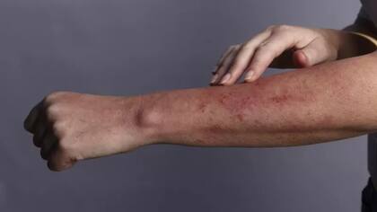 Covid-19: 4 extraños síntomas de coronavirus de los que quizás no hayas oído hablar