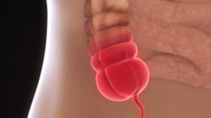 El apéndice es una pequeña prolongación del intestino grueso