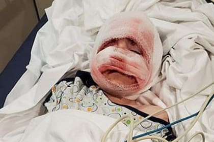 Cuando su madre lo pudo ver en el hospital, el pequeño se encontraba con el rostro completamente cubierto por gasas