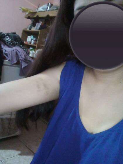 Damaris Bustamante muestra las marcas del maltrato físico en el hospital