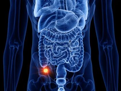 De acuerdo con el Instituto Nacional del Cáncer de Estados Unidos, el cáncer de apéndice es muy poco común