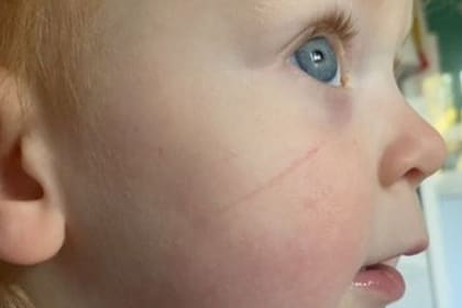 De este modo se veía el rasguño que encontraron en la pequeña