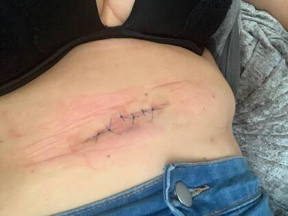 De la experiencia le quedó una cicatriz, y una lección de vida (Facebook)