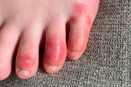 Las erupciones en los dedos del pie podrían ser un nuevo síntoma de coronavirus