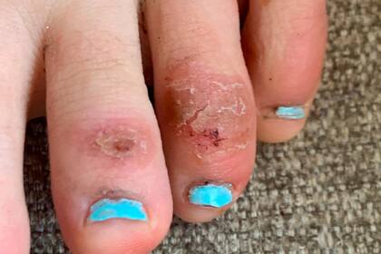 Según informaron, se trata de hinchazones rojas, dolorida, que a veces produce picazón en los dedos de los pies y parecen sabañones