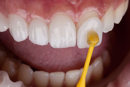Las carillas sirven para tratar problemas como el esmalte dañado y los espacios entre los dientes