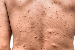 Brote de varicela en Entre Ríos: reportan más de 700 casos