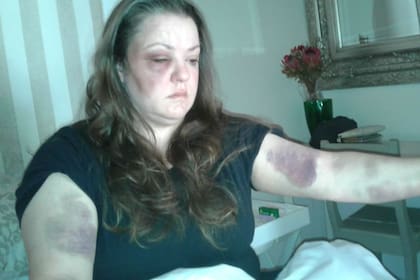 Desireé van Schalkwyk muestra sus heridas luego de que ella y su esposo fueran atacados en una granja en las afueras de Porterville en el Cabo Occidental en noviembre de 2018