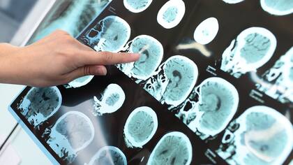 Día de la Esclerosis Múltiple