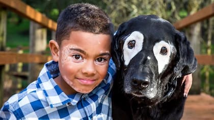 Día Mundial del Vitiligo