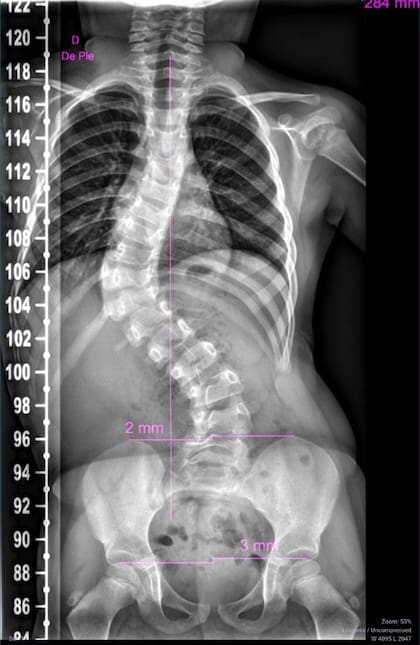 Días atrás, recibieron un nuevo diagnóstico: angulación por escoliosis de 78 grados