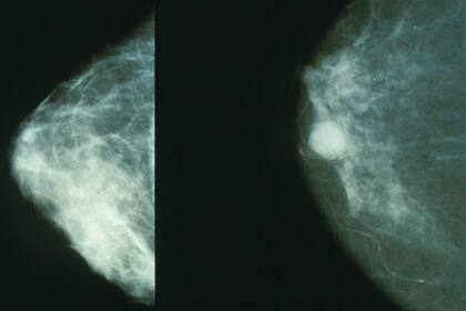 Diseminación del cáncer dentro de la mama (izq), luego de su detección (der)
