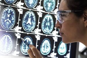 Dos buenas noticias sobre el tratamiento de la enfermedad de Alzheimer (y una mala de otras formas de demencia)