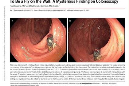 Durante la revisión de rutina del colon de un hombre, se descubrió a una mosca que se había alojado en la pared intestinal