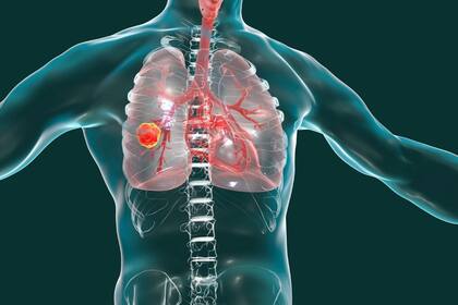 El 15% de los pacientes diagnosticados con cáncer de pulmón nunca fumaron