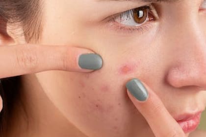 El acné es una irritación en la piel y puede tener diversos tratamientos (Foto Pexels)