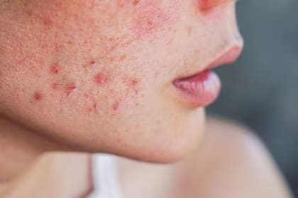 El acné suele afectar más a los jóvenes