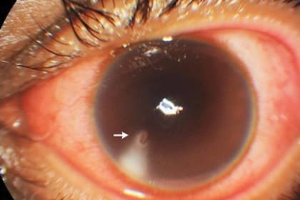 El aguijón está insertado en la parte inferior de la córnea y produjo una opacidad a su alrededor, que le provocó al paciente irritación y disminución de la visión