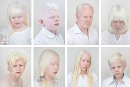 El albinismo, que altera la pigmentación en la piel, el cabello o los ojos, es uno de los temas que aborda Mónaco en sus trabajos