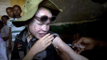 El albinismo es una condición genéticamente heredada que afecta la pigmentación del cuerpo. Causa una discapacidad visual compleja y coloca a las personas con albinismo en mayor riesgo de cáncer de piel