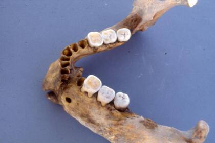 El análisis de los dientes reveló una línea de placa que se acumulaba donde se enhebraba un alambre delgado