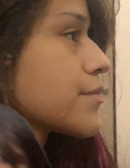 El antes de la cirugía de la joven que hizo que su novio infiel le pagara la intervención